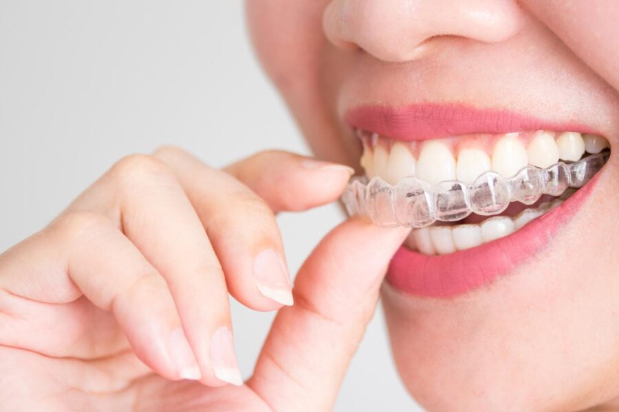Person inserting a clear Invisalign aligner onto their upper teeth, showing how Invisalign helps correct overbites.