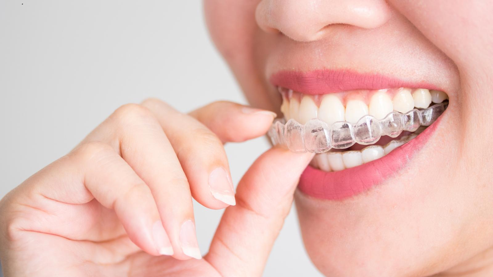 How Invisalign Helps Correct Overbites