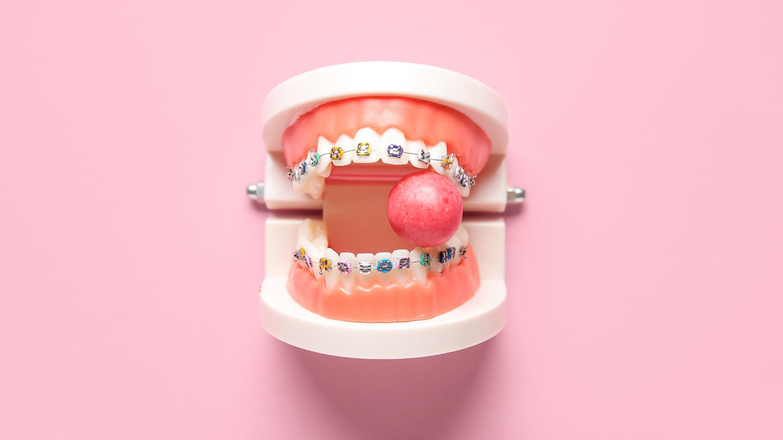 Is Gum Safe to Chew With Braces? The Truth