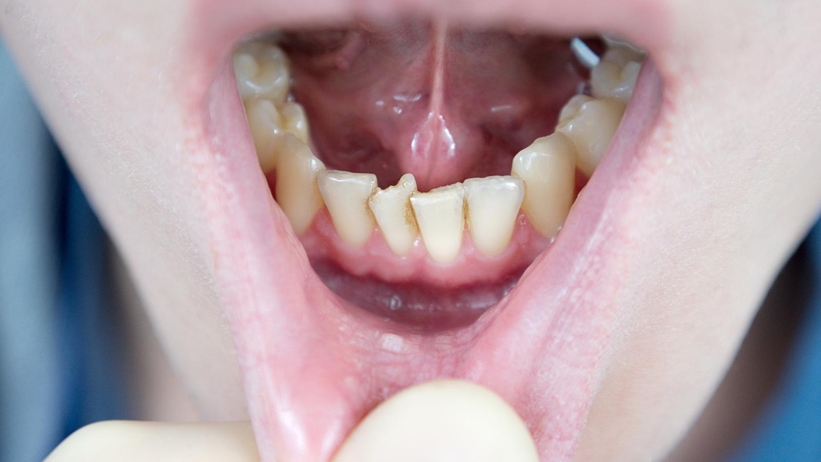 orthodontist viewing a person's crooked teeth.