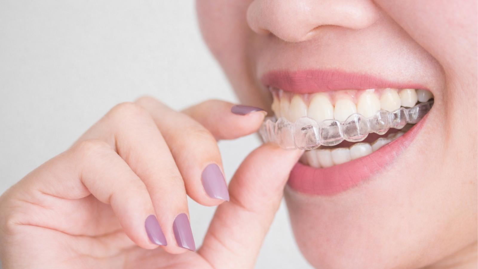 teen inserting invisalign braces.