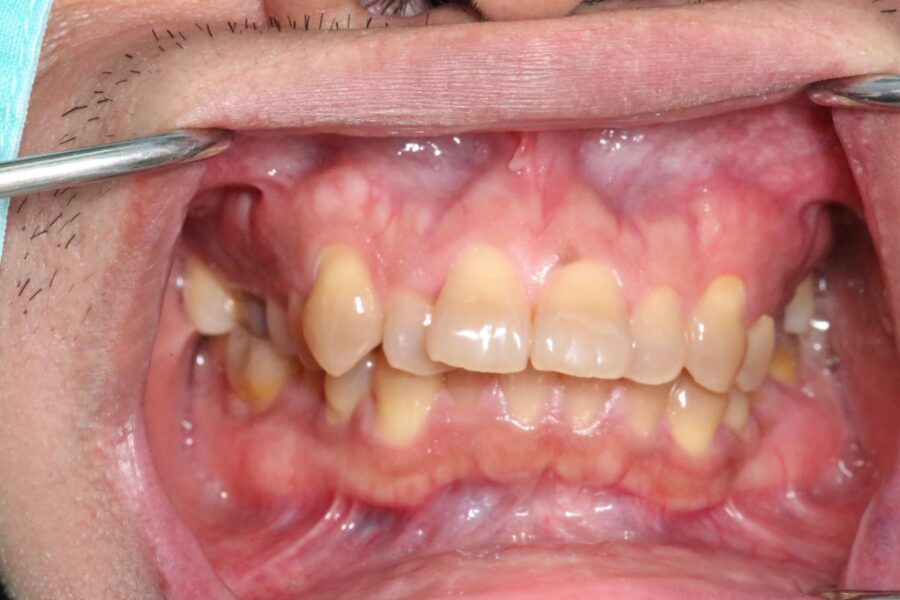 severe malocclusion