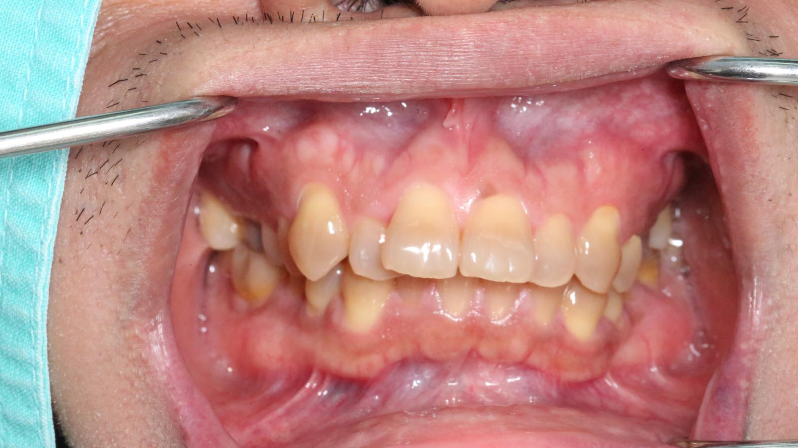 How to Fix Malocclusion: Treatment Options Explained