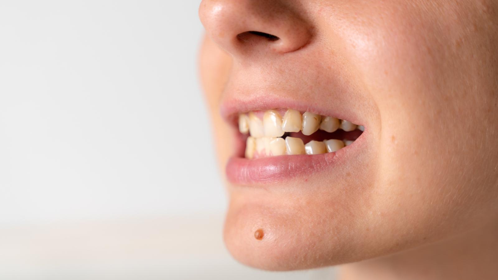 Person with malocclusion
