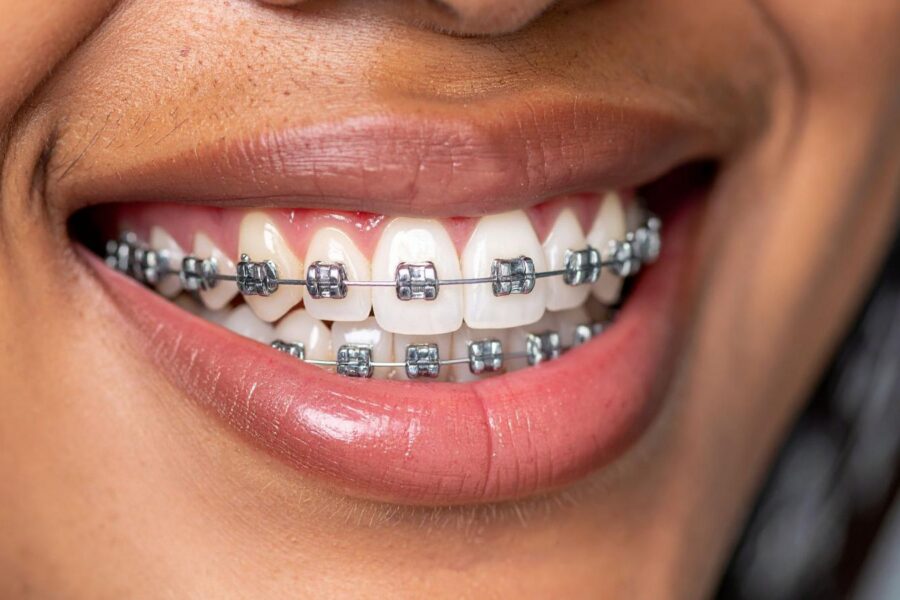 what age can a kid get braces