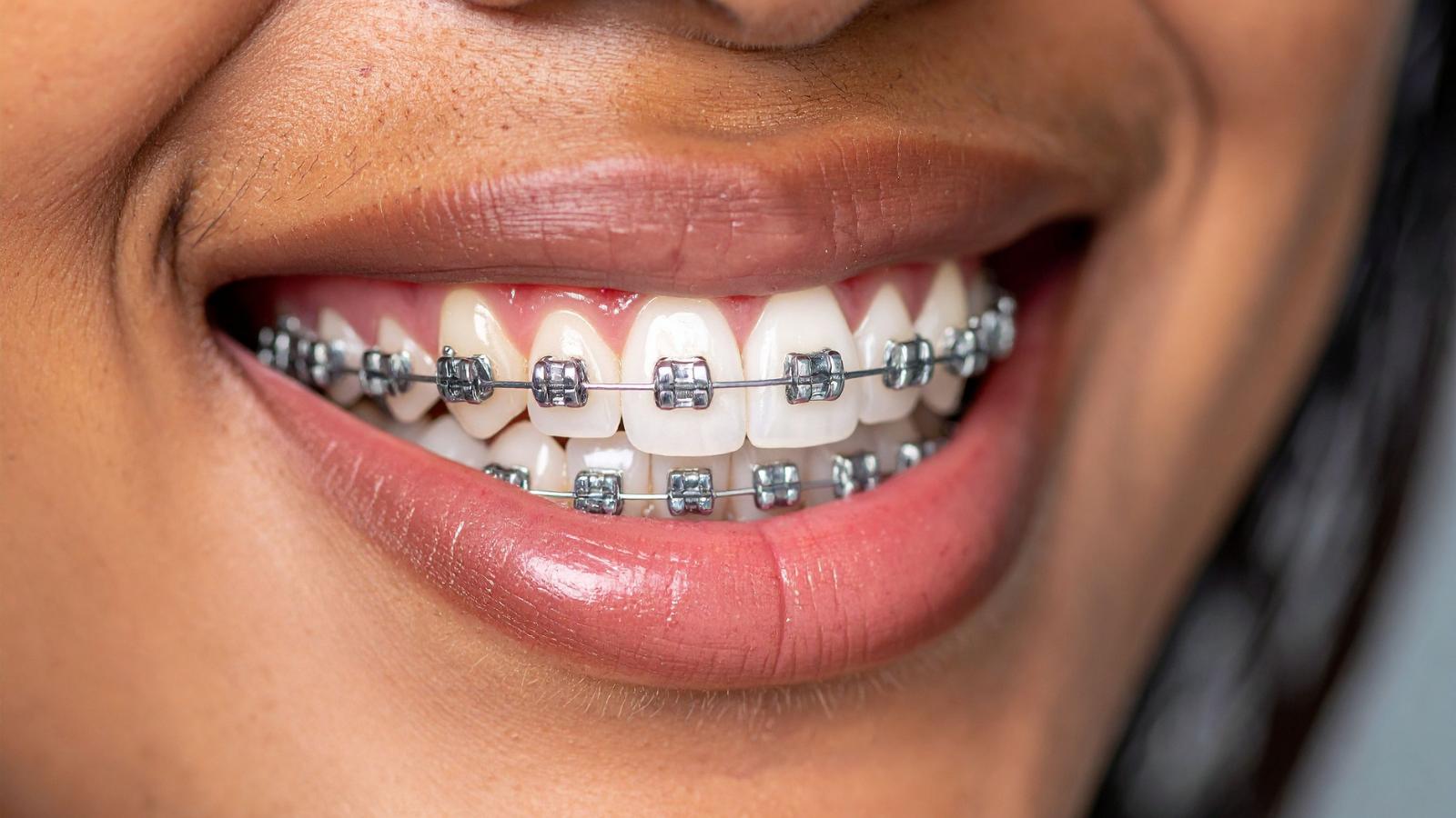 When Do Kids Get Braces? Ages & Options Explained