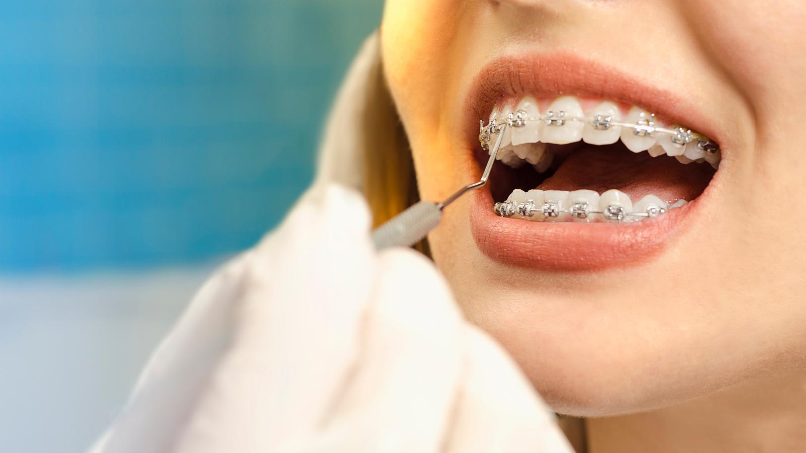 Can Adults Get Braces? Treatment Tips for Adults
