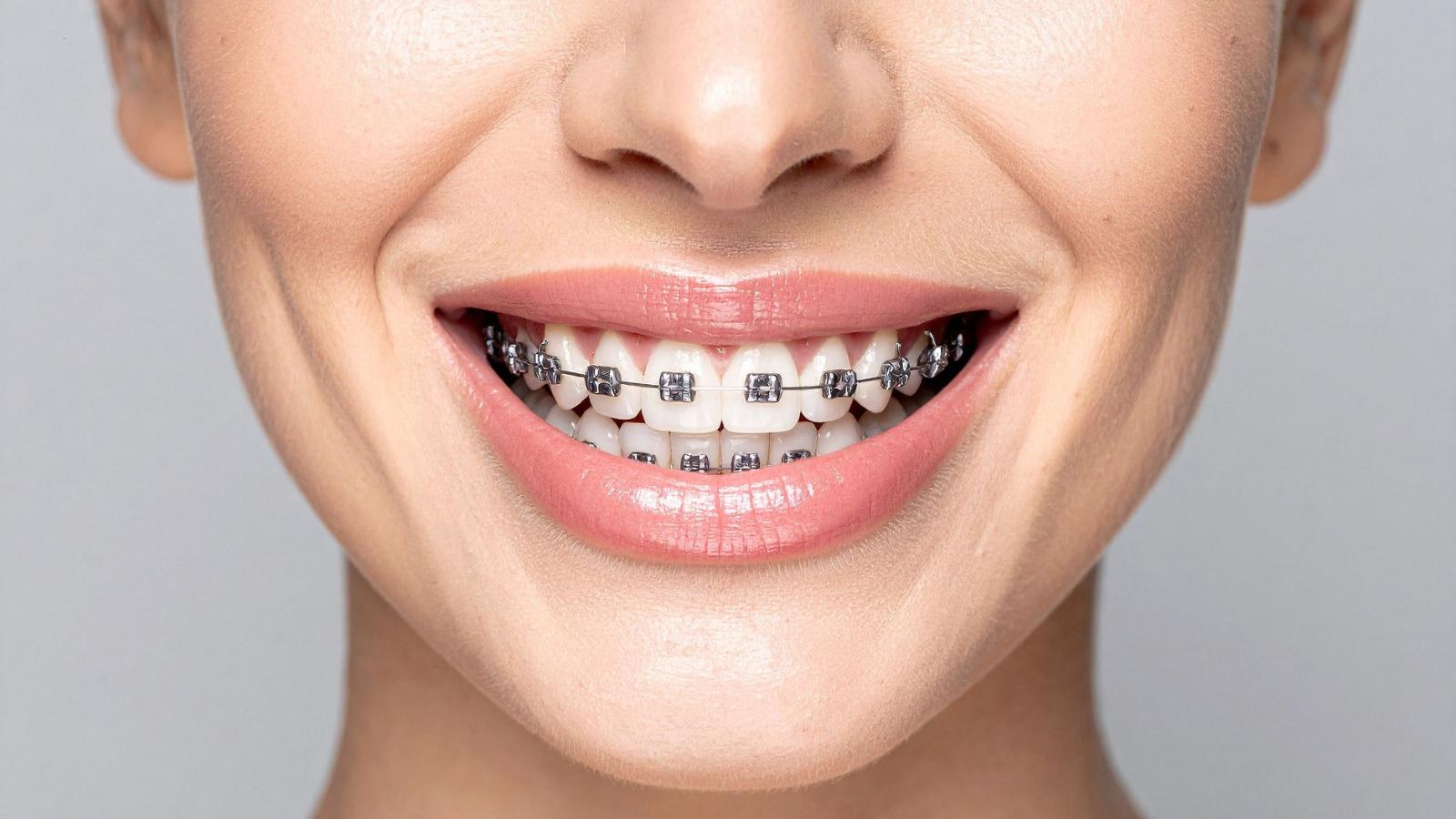 woman smiling with braces on.