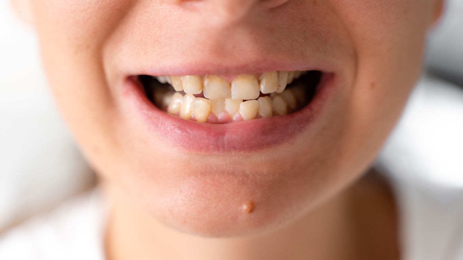 person with crossbite smiling