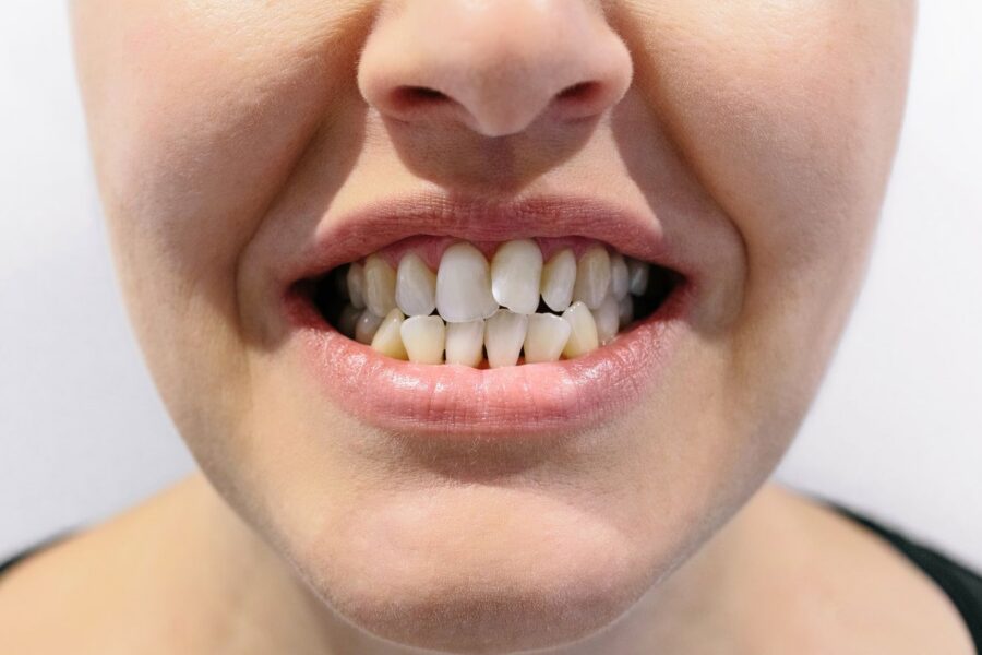 adult with crossbite