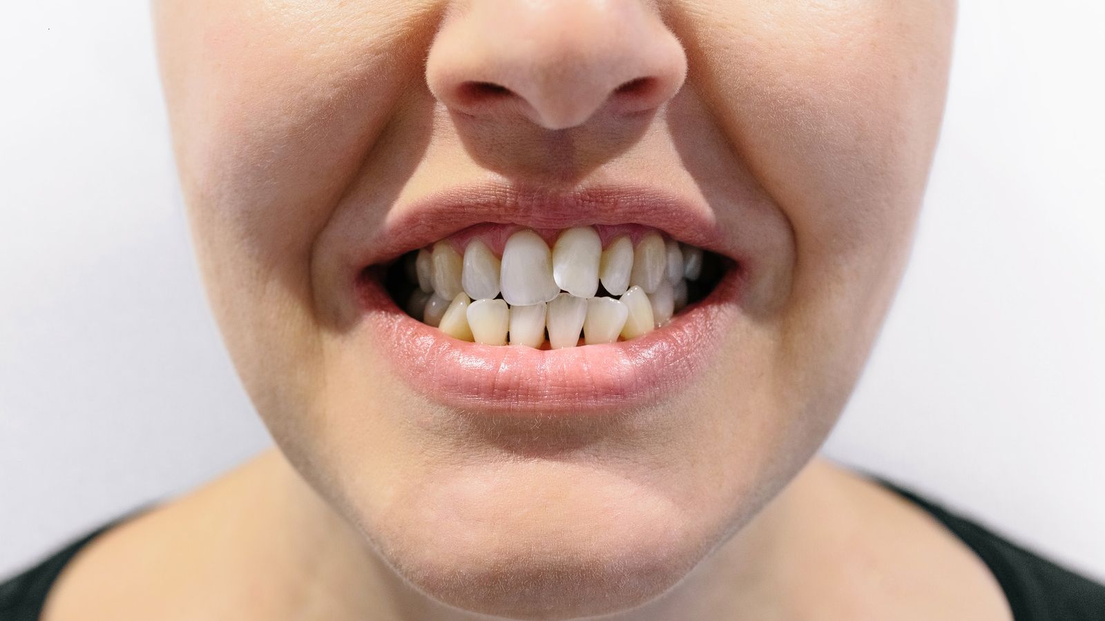 How to Fix a Crossbite in Adults: Treatment Options